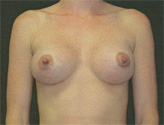 Patient # 38532 After Photo # 2