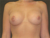 Patient # 60496 After Photo # 2