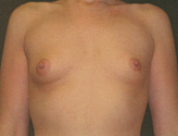 Patient # 60496 Before Photo # 1