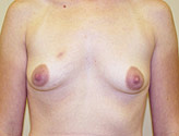 Patient # 69497 Before Photo # 1