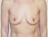 Patient # 50657 Before Photo # 1