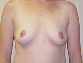 Patient # 59843 Before Photo # 1