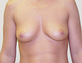 Patient # 61302 Before Photo # 1