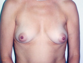 Patient # 91588 Before Photo # 1