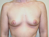 Patient # 70917 Before Photo # 1