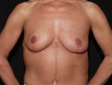 Patient # 68062 After Photo # 2