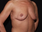 Patient # 68062 After Photo # 4