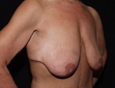 Patient # 68062 Before Photo # 3