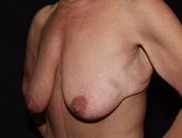 Patient # 68062 Before Photo # 5