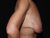 Patient # 68062 Before Photo # 7