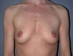 Patient # 24340 Before Photo # 1