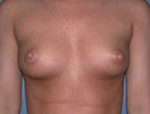 Patient # 22344 Before Photo # 1
