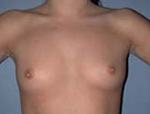 Patient # 29357 Before Photo # 1