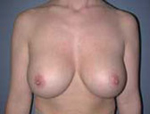 Patient # 44359 After Photo # 2