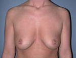 Patient # 44359 Before Photo # 1