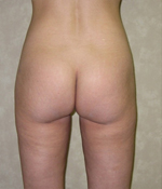 Patient # 57805 After Photo # 2