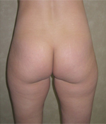 Patient # 57805 Before Photo # 1