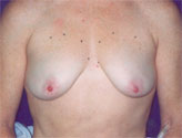 Patient # 97293 Before Photo # 1