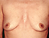 Patient # 91334 Before Photo # 1
