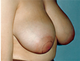 Patient # 95981 Before Photo # 3