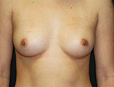 Patient # 21405 Before Photo # 1
