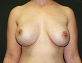 Patient # 18297 After Photo # 2