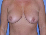 Patient # 90408 After Photo # 2