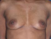 Patient # 15478 Before Photo # 1