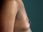 Patient # 13036 Before Photo # 3