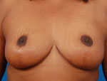 Patient # 13143 After Photo # 2