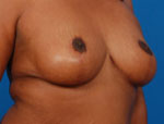Patient # 13143 After Photo # 4