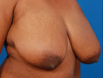 Patient # 13143 Before Photo # 3