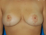 Patient # 84655 After Photo # 2