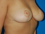 Patient # 84655 After Photo # 4