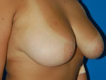 Patient # 84655 Before Photo # 3