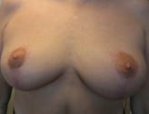 Patient # 73381 After Photo # 2