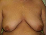 Patient # 73381 Before Photo # 1