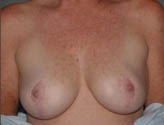 Patient # 39883 After Photo # 2