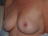 Patient # 39883 After Photo # 4