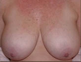 Patient # 39883 Before Photo # 1