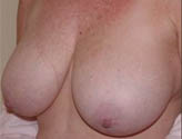 Patient # 39883 Before Photo # 3