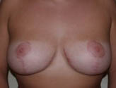Patient # 78887 After Photo # 2