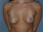 Patient # 44551 Before Photo # 1