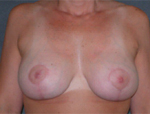 Patient # 16447 After Photo # 2
