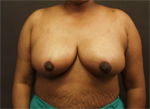 Patient # 12229 After Photo # 2