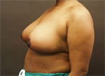 Patient # 12229 After Photo # 4