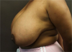 Patient # 12229 Before Photo # 3