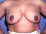 Patient # 85293 After Photo # 2