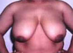 Patient # 85293 Before Photo # 1