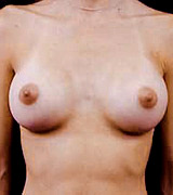 Patient # 86687 After Photo # 2